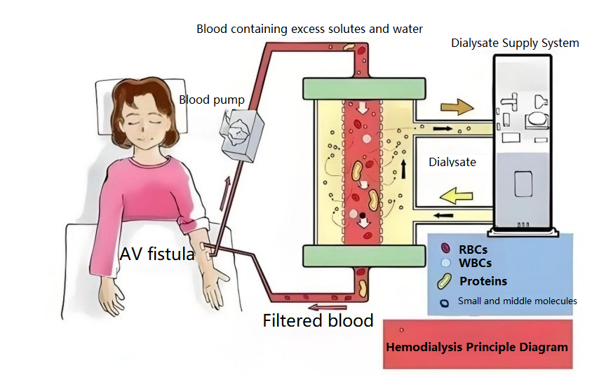 Application of Reverse Osmosis Water in Hemodialysis